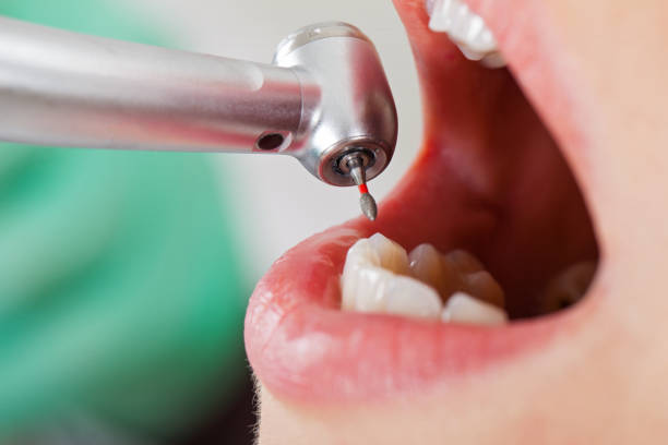 Best Emergency Wisdom Teeth Removal in Lake Arrowhead, ME